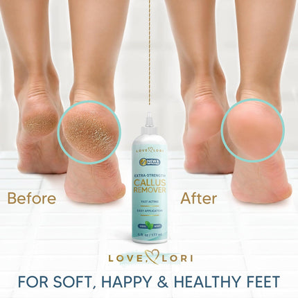 Extra Strength Callus Remover Gel, 6oz – Foot Scrubber & Pedicure Tools for Smooth Feet