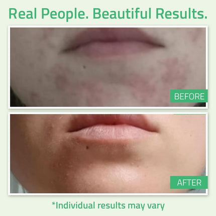 Glycolic Acid 30% Face Peel – At-Home Chemical Exfoliator with Retinol