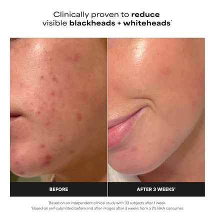 SKIN PERFECTING 2% BHA Liquid Exfoliant, Salicylic Acid Face Exfoliator Pores & Blackheads